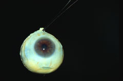 enucleated eye